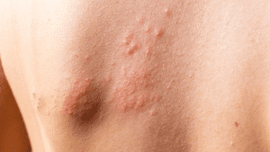 Person with chronic hives on the back
